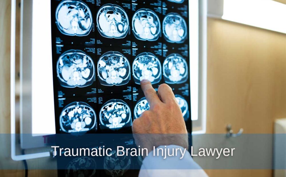 A physician highlights an X-ray on the wall, emphasizing details pertinent to traumatic brain injury legal cases.