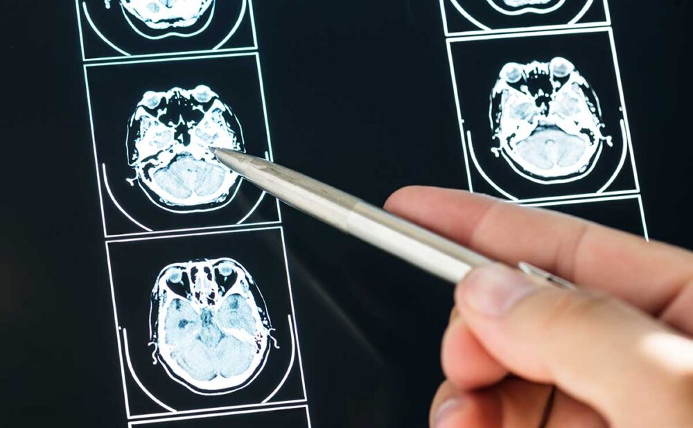 A medical professional studies an MRI image with a pen in hand, emphasizing the hidden dangers of traumatic brain injuries in car crashes.