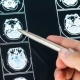 A medical professional studies an MRI image with a pen in hand, emphasizing the hidden dangers of traumatic brain injuries in car crashes.